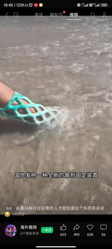 国外有镂空型的新型骨折固定装置，在一….-航海圈